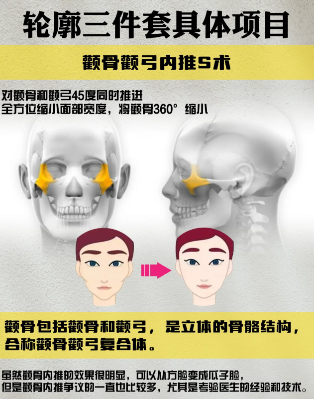 六、下颌角手术修复的优势