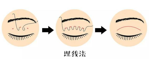 切开双眼皮线结反应修复时间
