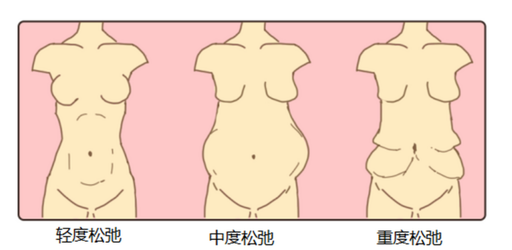 三、 想找王国栋做腹壁整形？这些术前功课你必须做