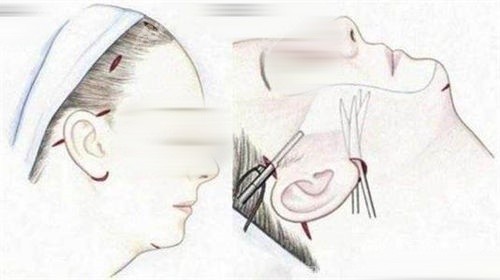 北京华韩高亚东拉皮手术贵不贵？V双层提升技术解析+价格明细+网友分享