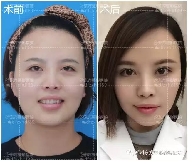 郑州东方整形贺洁眼袋修复怎么样？小创口、一术三效，高成功率方案助您告别眼袋烦恼！ 