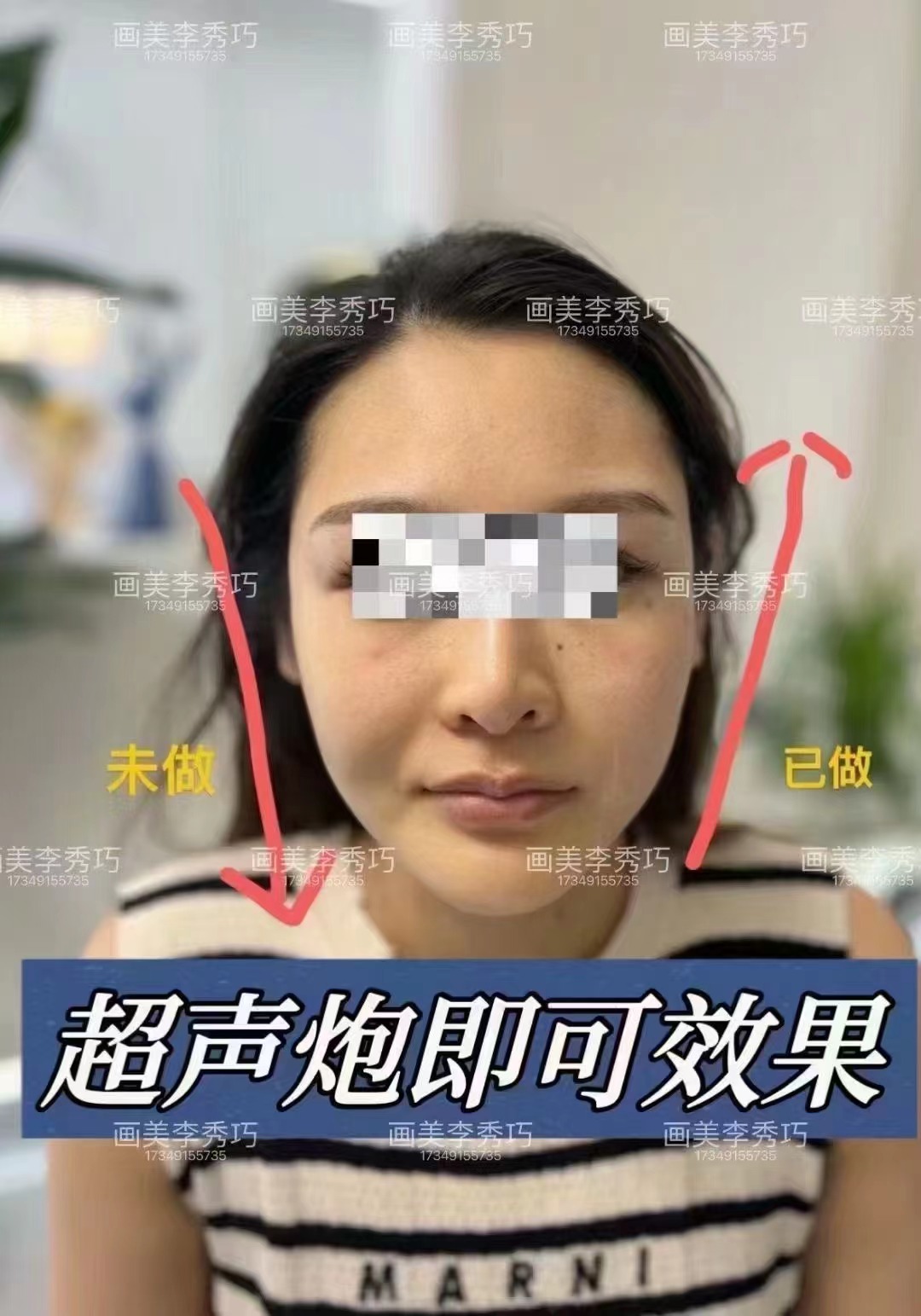 热玛吉和超声炮哪个好：中重度松弛场景对比