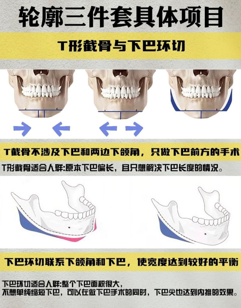 六、除了磨骨，项昌峰医生还擅长什么？鼻综合与复合隆胸的技术特点