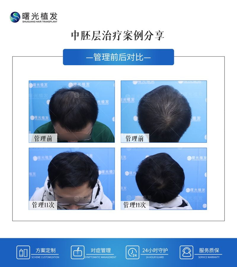 广州曙光范丹微孔祛眼袋临床反馈如何？