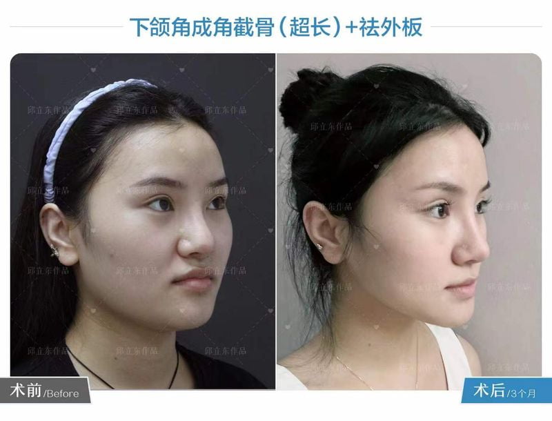 三、除了磨骨，项昌峰医生擅长什么手术？鼻综合与复合隆胸的技术看点