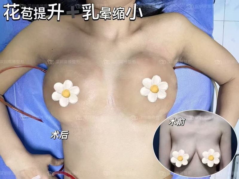 深圳南雅医院做胸怎么样？何奇/梁智技术靠谱，花苞提升术19800元起/傲诺拉98000元起