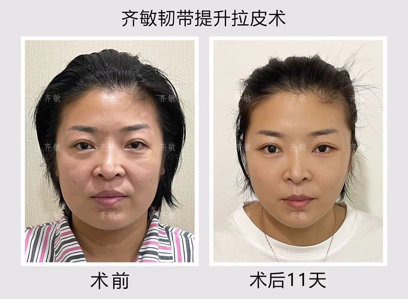 北京美莱翟红宇全脸抗衰怎么样，精通眼周口周精细化抗衰操作，先提升后支撑的打法兼顾紧致度与自然感