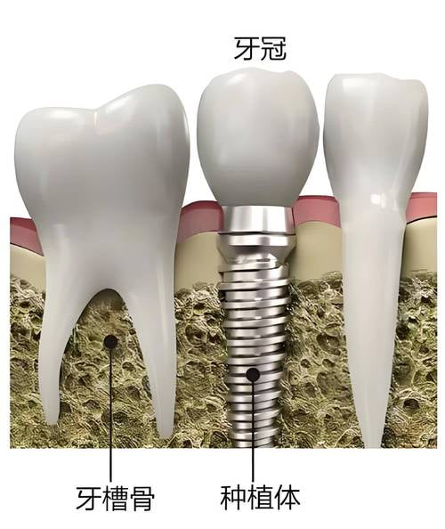 抖友晒半口全口种植牙6年后100字真实感受：生活质量大提升
