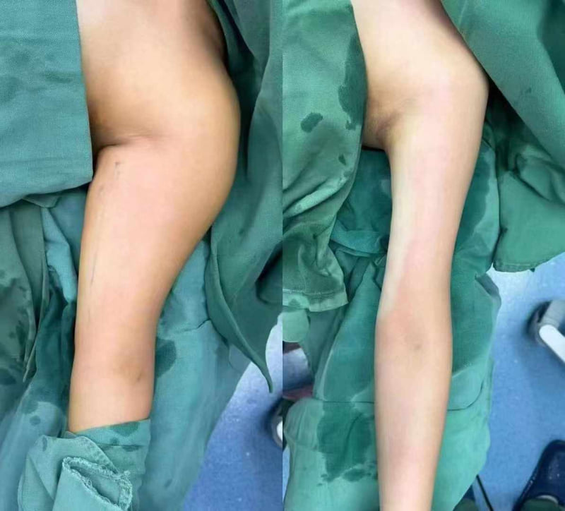 重庆华美周壮医生吸脂怎么样？多维立体技术打造平整身材，疤痕管控效果佳 