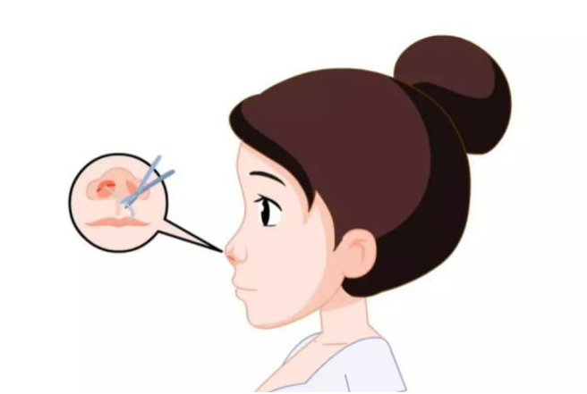如何选择适合你的隆鼻方案？一份实用指南