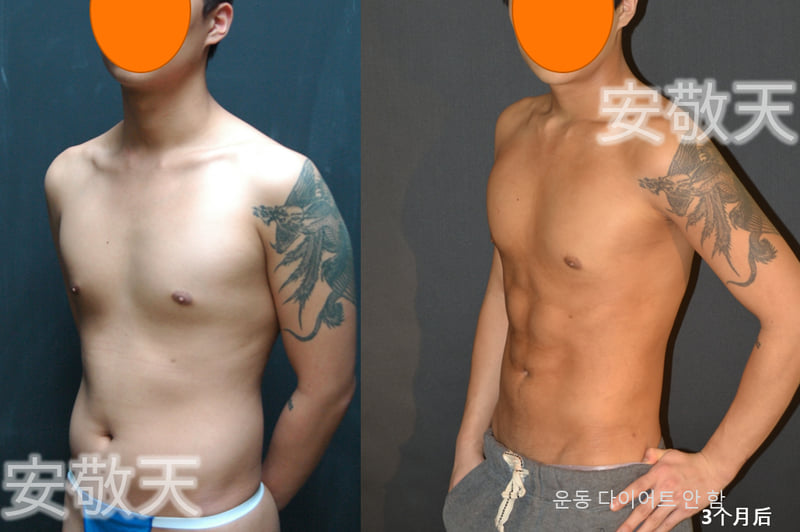 三、蒋华医生吸脂设备与操作优势