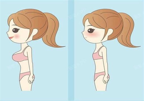 长沙雅美王晓朋医生假体隆胸实例揭秘：零包膜挛缩+91.2%真实触感，产后妈妈也能自然美胸！