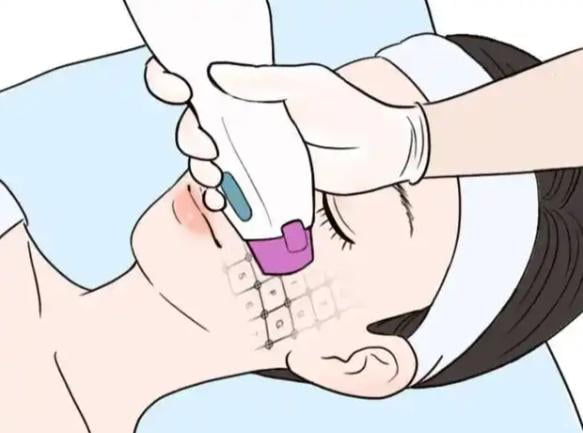 三、除了价格,在温州和平医院做热玛吉还要注意什么?