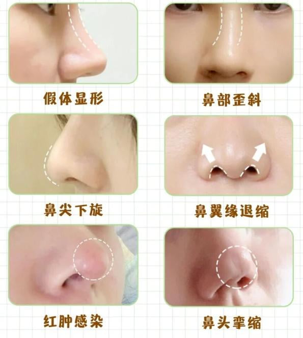 1. 技术扎实：深耕鼻整形与高难度鼻修复