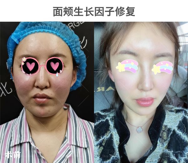 郑州于艳菊教授去生长因子怎么样？20年经验+特色技术，取出率高且复发率低 