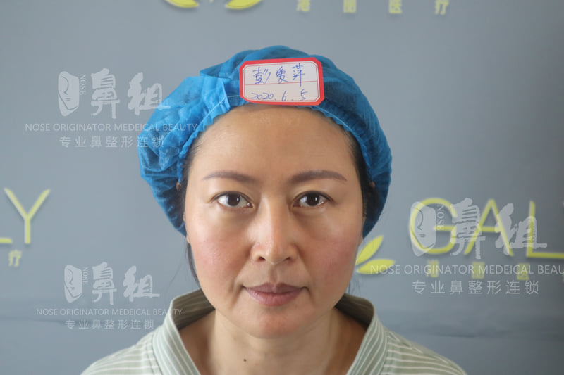 上海伯思立沈国雄:自然微创鼻修复医生