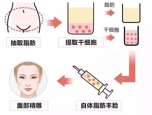 Q1：吸脂失败后多久可以找张红芳博士做修复？