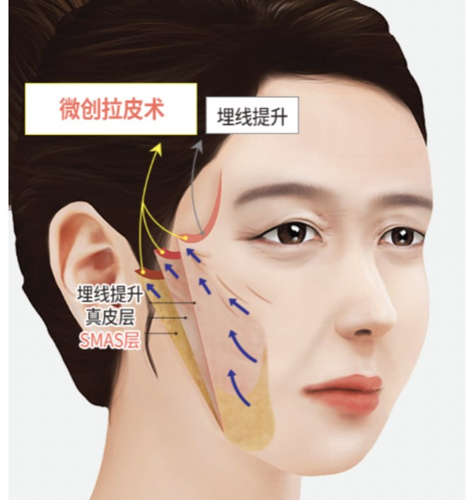 四、关于拉皮手术价格与疗效的理性预期管理
