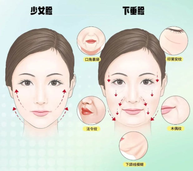一、魏广运面颈提升的真实反馈,为什么总绕不开“韧带复位”?