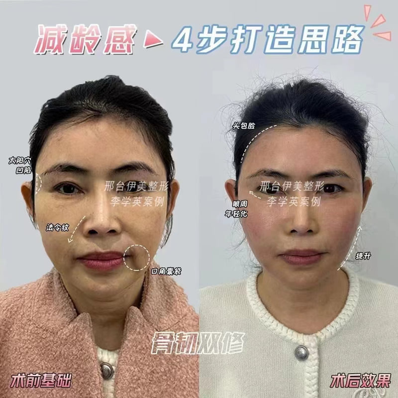 蔡跃波面部提升三件套之术式构成