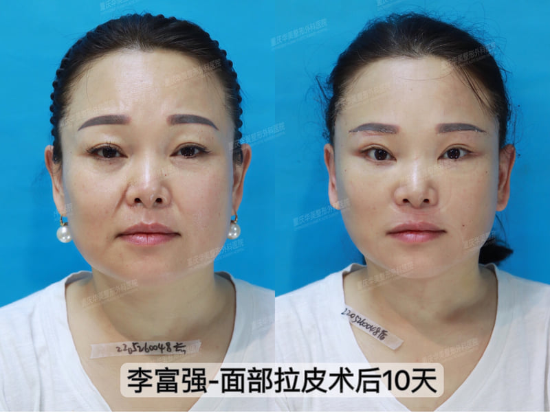 广州华美胡晓焕，伊妍仕指定医师，精雕轮廓填充，效果自然不假面！