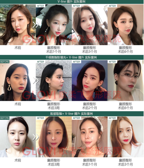 V脸提升前后对比照