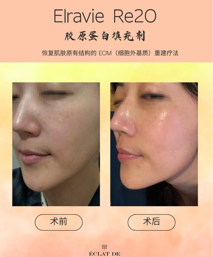 Re2o胶原蛋白填充对比
