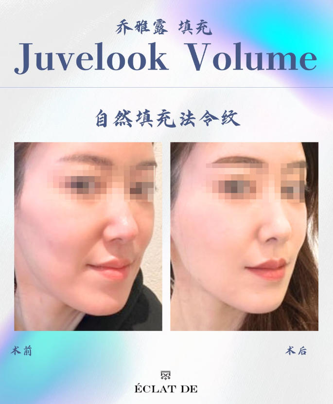 乔雅露填充对比