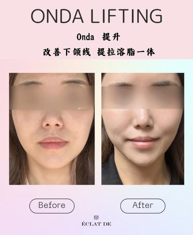 Onda提升前后对比照片